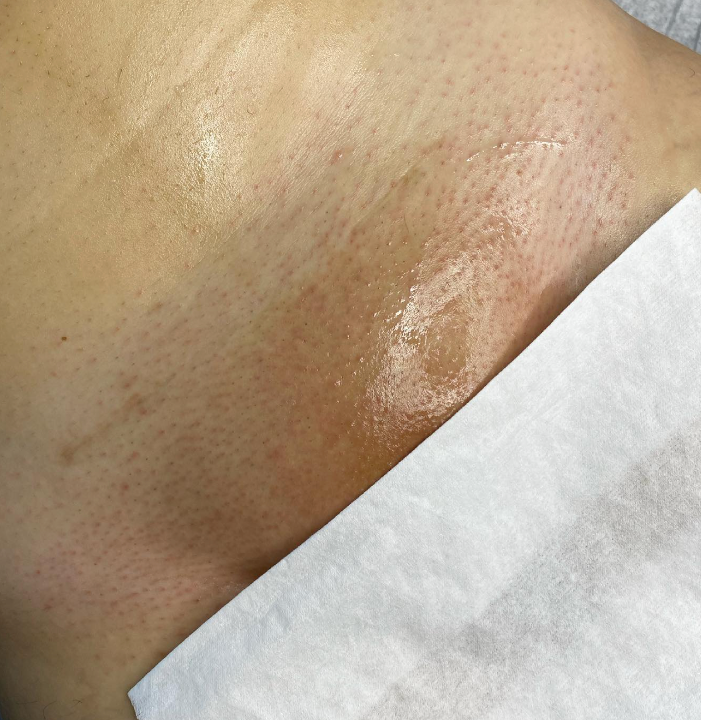 Brazilian Waxing Before And After