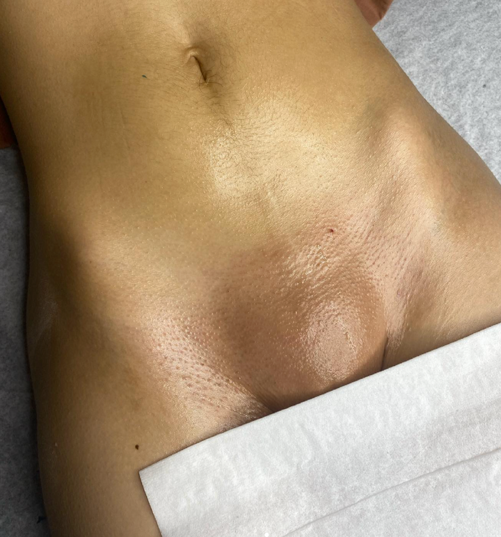 Brazilian Wax Before and After Tagged "Wax Junkie"