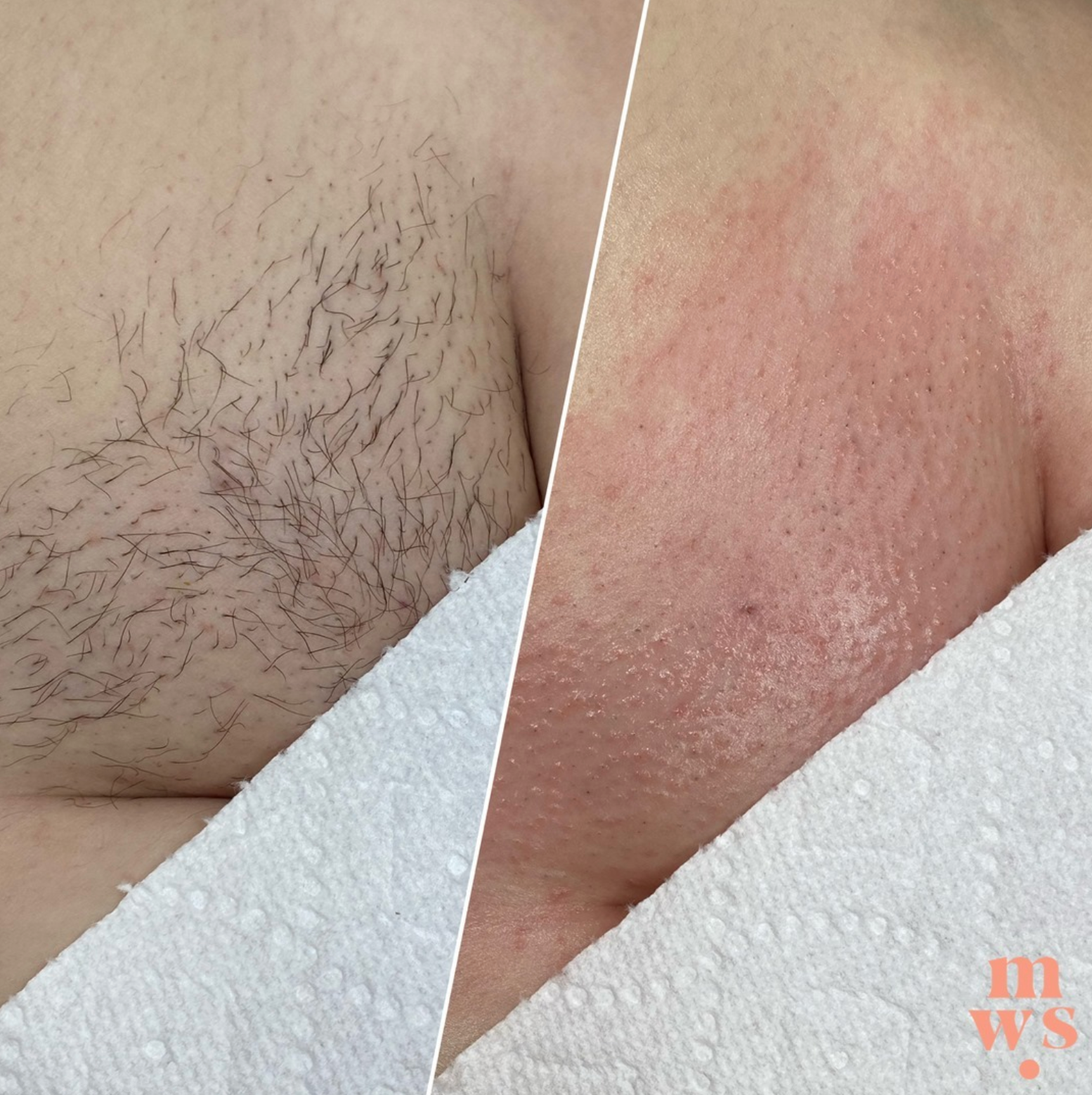 Before And After Photos Of Brazilian Wax