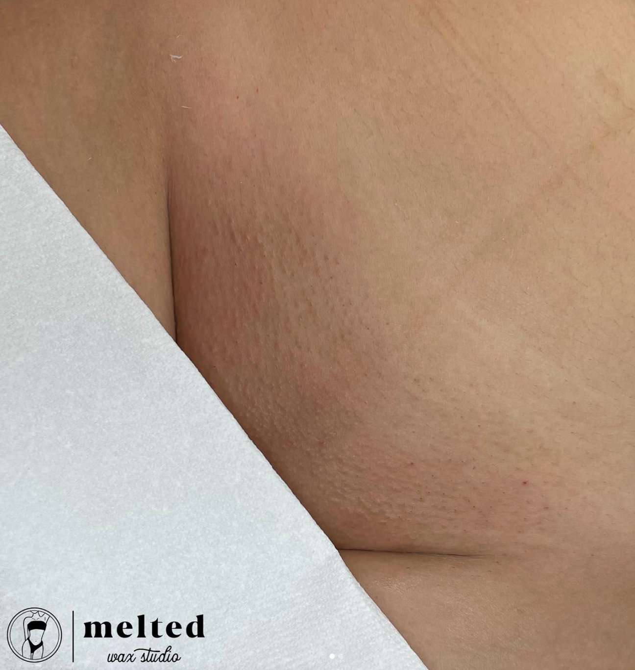 Brazilian Wax Before and After – Page 4 – WAXINGPROS.COM